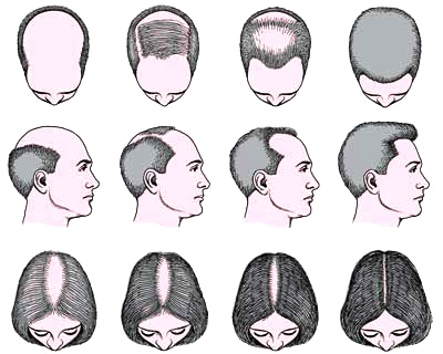 hair transplantation