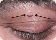 Unwanted Skin Growth